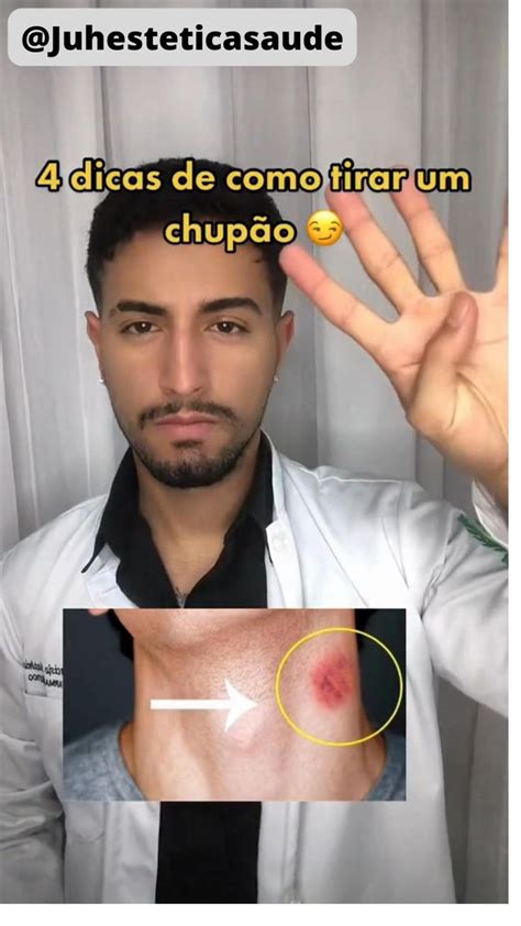 chupão no peito|Estou com muito medo, tudo por conta de um chupão